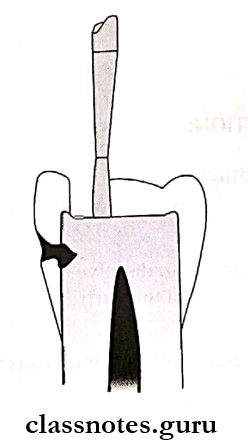 Amalgam Extend the bur keeping it parallel to the long axis of tooth