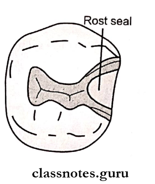 Amalgam For abutment teeth, facial and lingual wals are extended for providing rest seat