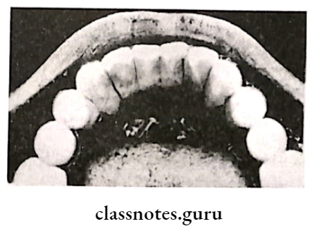 Calculus And Other Etiological Factors Supra gingival calculus on the lingual surfaces of lower anterors