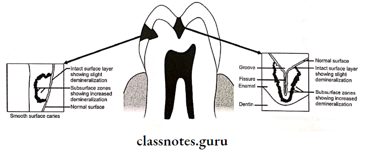 Dental Caries Magnified schematic presentation of smooth surface caries
