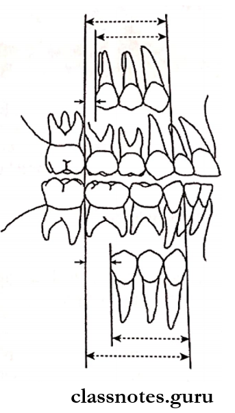 Development Of Dentition Leeway space of Nance