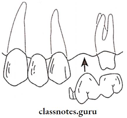 Fixed Partial Denture Distal Segment