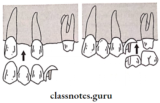 Fixed Partial Denture The Mesial Segment And Distal Segment