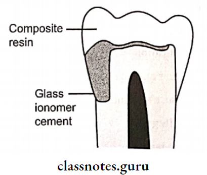 Glass Ionomer Cement Sandwich technique- Gloss ionomer is placed in prepared tooth, over which composite resin is placed as laminate