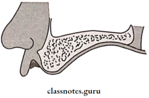 Impression And Mouth Preparation - Class Notes