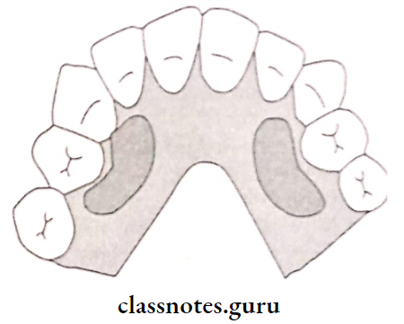 Impression And Mouth Preparation Tori On The Mandibular Premolar Area