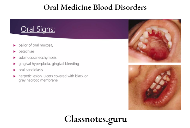 Oral Medicine Blood Disorders
