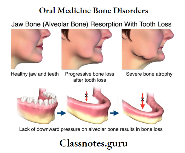 Oral Medicine Bone Disorders