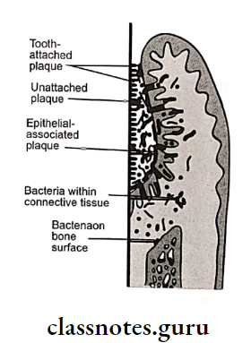Oral Medicine Periodontal Disease Diagram depicting the plaque bacteria association with tooth surface and periodontal tissues.