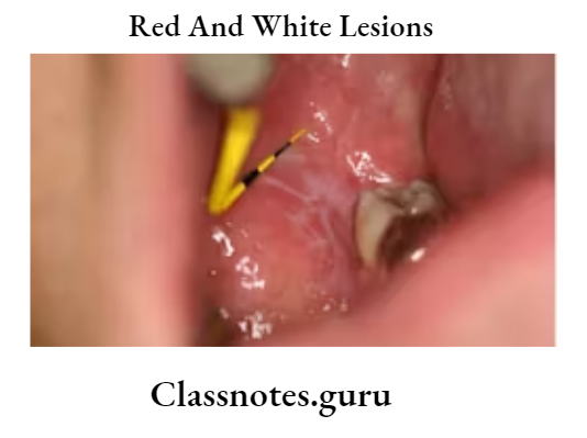 Oral Medicine Red And White Lesions