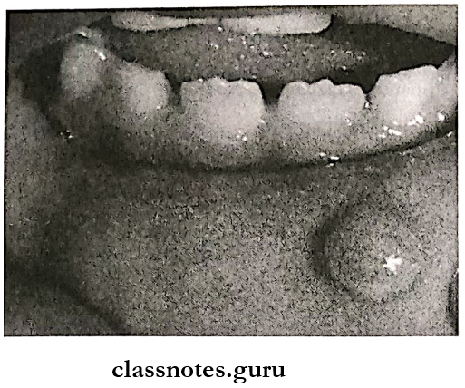 Oral Medicine Salivary Glands Mucocele