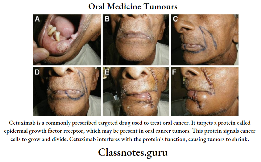 Oral Medicine Tumours.