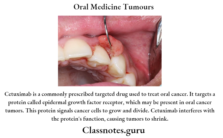 Oral Medicine Tumours