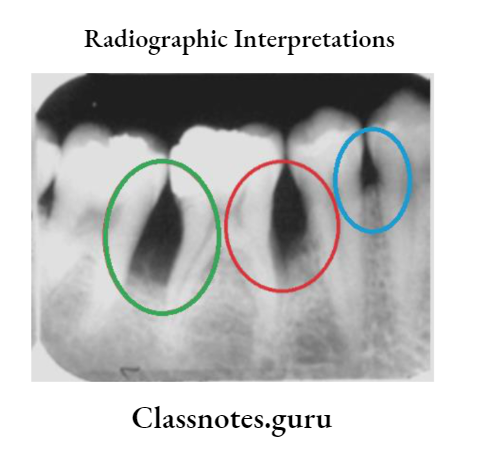 Oral Radiology Radiographic Interpretations A Periapical radiographs showing examples of vertical bone loss
