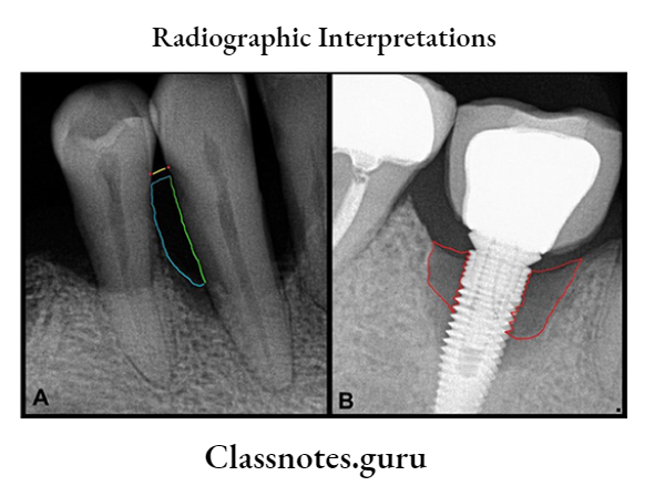 Oral Radiology Radiographic Interpretations Periapical radiographs showing the typical radiographic features