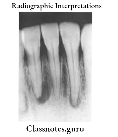 Oral Radiology Radiographic Interpretations Periapical showing a well defined area of radiolucency at the apex