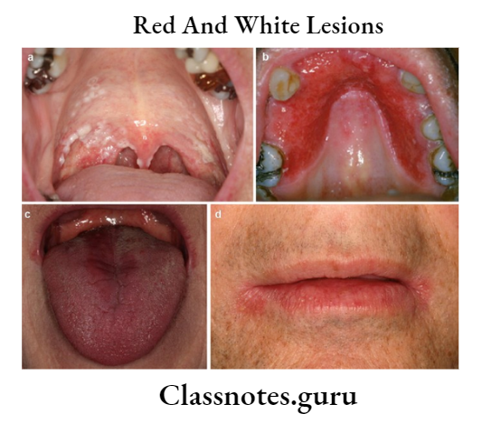 Red And White Lesions
