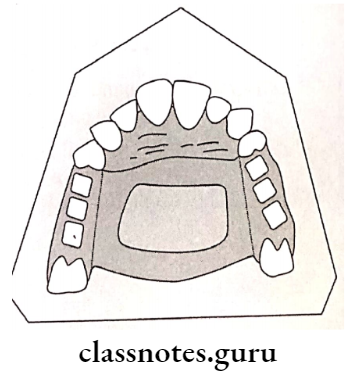 Removable Partial Dentures Anterior Posterior Doble Palatal Bar