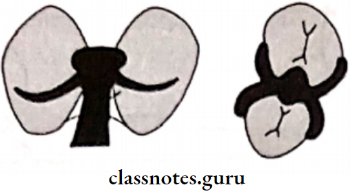 Removable Partial Dentures Embrasure Clasp