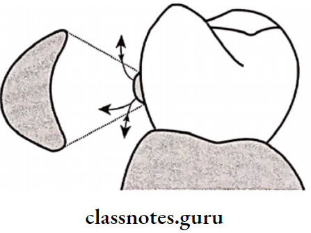 Removable Partial Dentures Half Round Clasp
