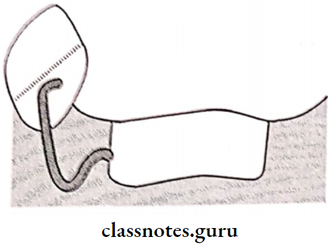 Removable Partial Dentures I Clasp