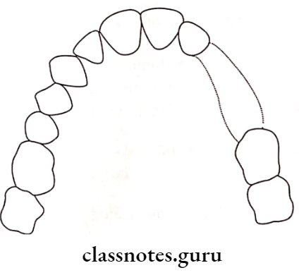 Removable Partial Dentures Kennedy Applegates Class 5 Partially Edentulous Condition
