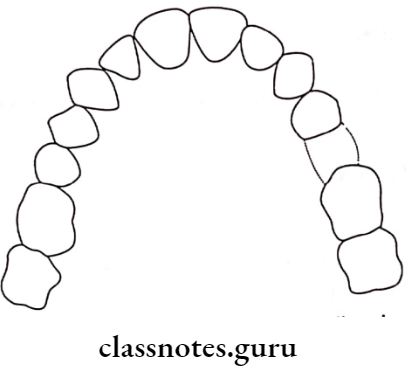 Removable Partial Dentures Kennedy Applegates Class 6 Partially Edentulous Condition