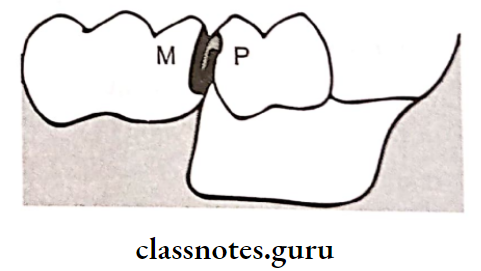 Removable Partial Dentures MAtrix And Patrix Of A Intracoronal Retainer