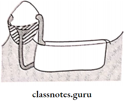 Removable Partial Dentures Mirror View clasp