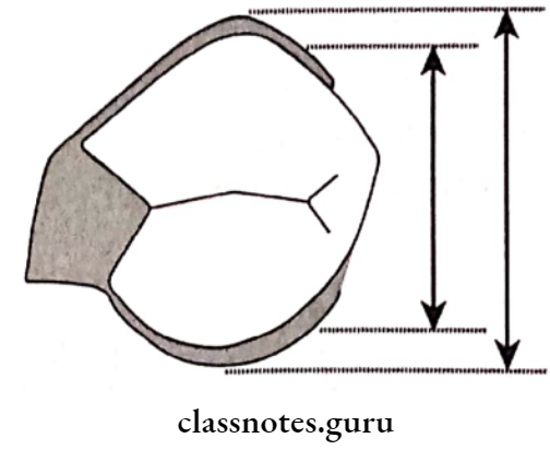Removable Partial Dentures Notice That A Cast Circumferential Clasp