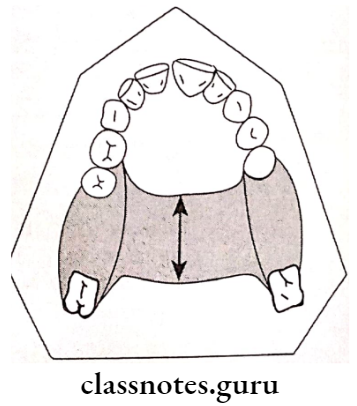 Removable Partial Dentures Palatal Strap