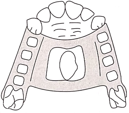 Removable Partial Dentures Relief Provided Avoid Interference From Large Inoperate Tori