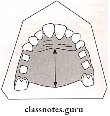 Removable Partial Dentures Single Broad Palatal Major Connector