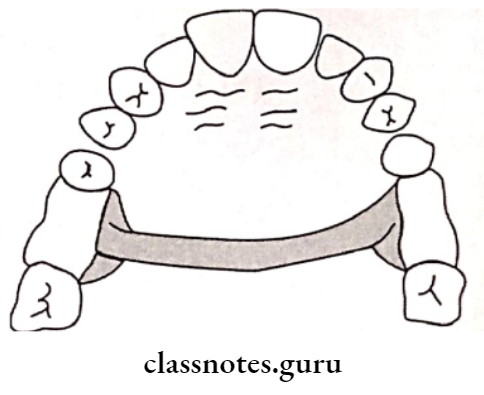 Removable Partial Dentures Single Posterior Palatal Bar