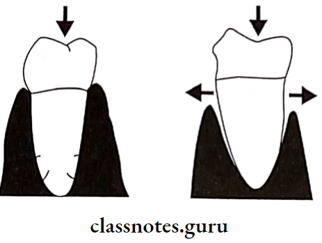 Removable Partial Dentures Sound Tooth Will Distribuet The Forces And A Periodontally Weak Tooth