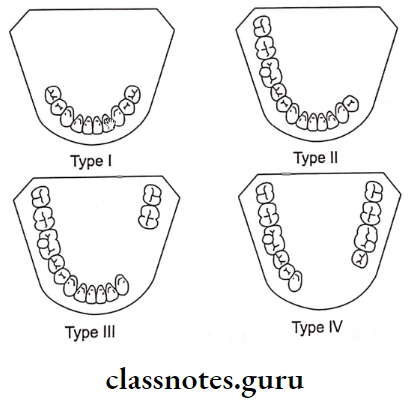 Removable Partial Dentures Teeth Are Preseny Only Posterior To The Edentulous Arch