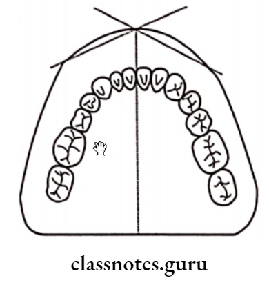 Removable Partial Dentures The Anterior Portion Of the Base Of The Maxillary Cast