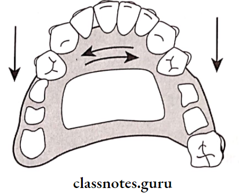 Removable Partial Dentures The RPD FrameWork Helps To Provide Stability