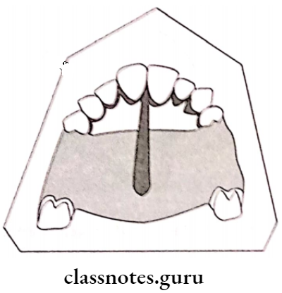 Removable Partial Dentures The Relief Area