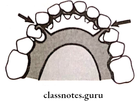 Removable Partial Dentures The Vertical Major Connector Supporting