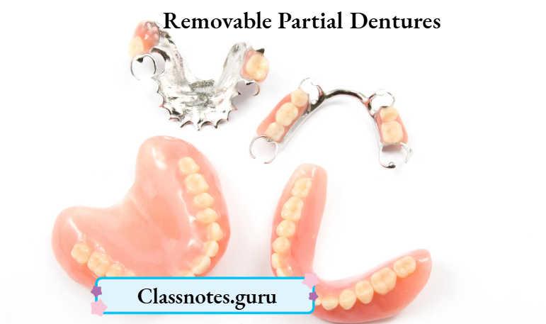 Removable Partial Dentures