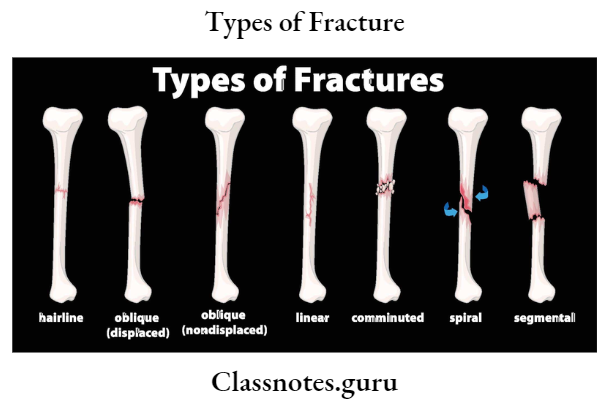 Types of Fracture Types of fracture