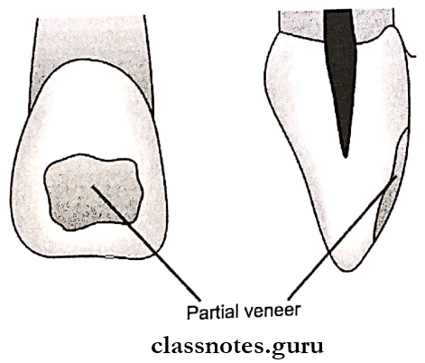 Veneers Direct partial veneer involving only localized surface of labial part of the tooth