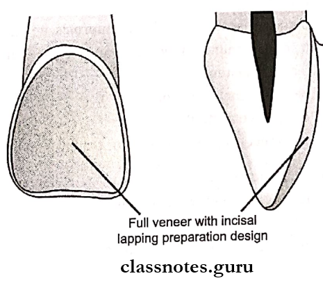 Veneers Full veneer with incisal lapping preparation