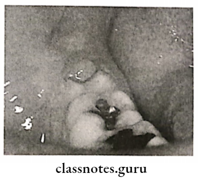 Acute Gingival Infections Pericoronitis thied molar partially covered by infected lap