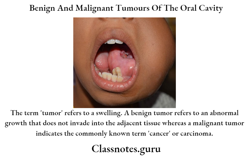 Benign And Malignant Tumours Of The Oral Cavity