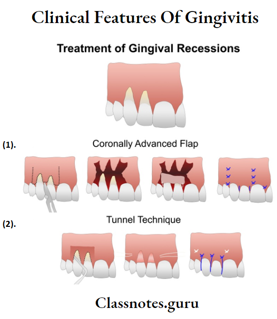 Clinical Features Of Gingivitis Treatment of Gingial recessions