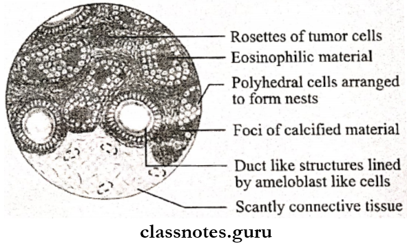 Cysts And Tumours Of Odontogenic Origin Histologic Features Of Adenoameloblastoma