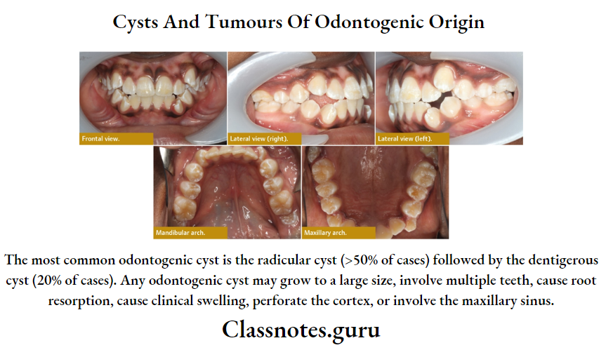 Cysts And Tumours Of Odontogenic Origin
