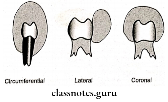 Cysts And Tumours Of The Orofacial Region Radiological Presentation Of Dentigerrous Cysts